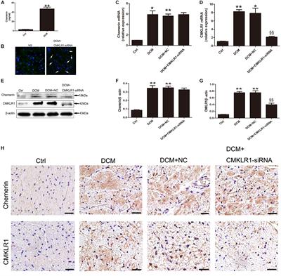 Chemerin/CMKLR1 Axis Promotes Inflammation and Pyroptosis by Activating NLRP3 Inflammasome in Diabetic Cardiomyopathy Rat